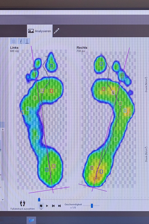 Pedografie bei Diabetes - Druckstellen erkennen anhand eines Fußscans